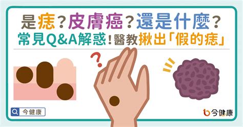 痣 形成原因|是痣？還是皮膚癌？皮膚科醫師教你揪出「假的痣」，。